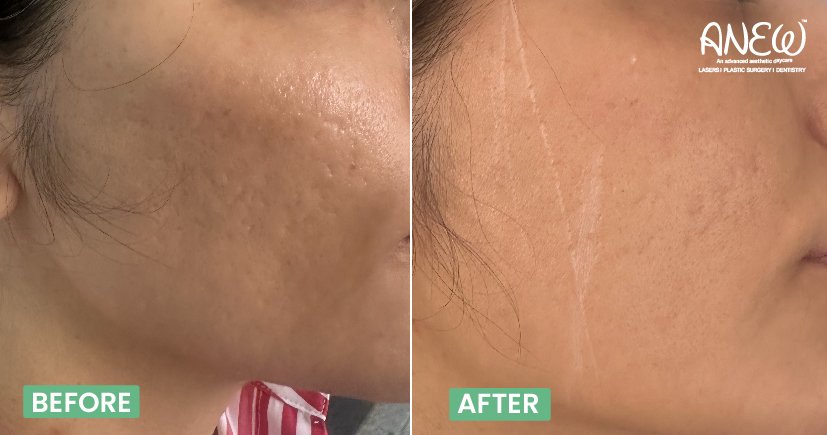 best botox treatment in bangalore​